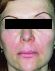 Microdermabrasion after