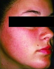 Microdermabrasion after