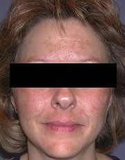 Microdermabrasion before