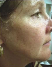 Microdermabrasion before
