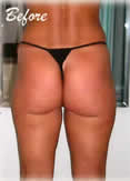 Body Mask Before