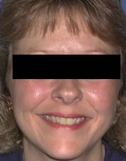 Microdermabrasion after