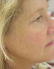 Microdermabrasion after