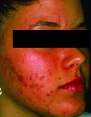 Microdermabrasion before