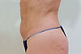 Ultrasound Treatment Spa New York