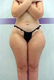 Ultrasound Treatment Spa New York