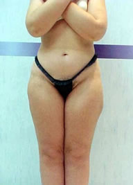 Ultrasound Treatment Spa New York