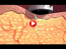 Ultrasound Treatment Spa New York